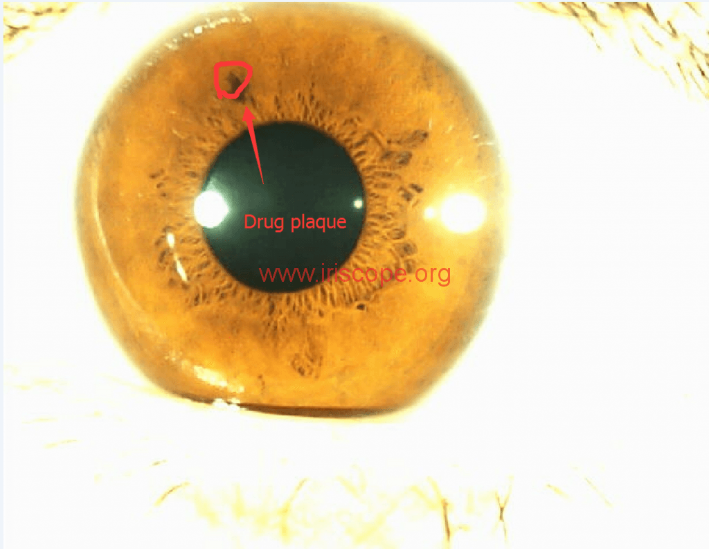 Drug plaque 5