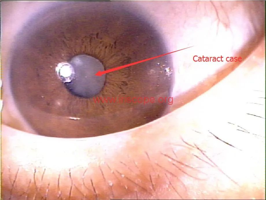 case iridology -cataract