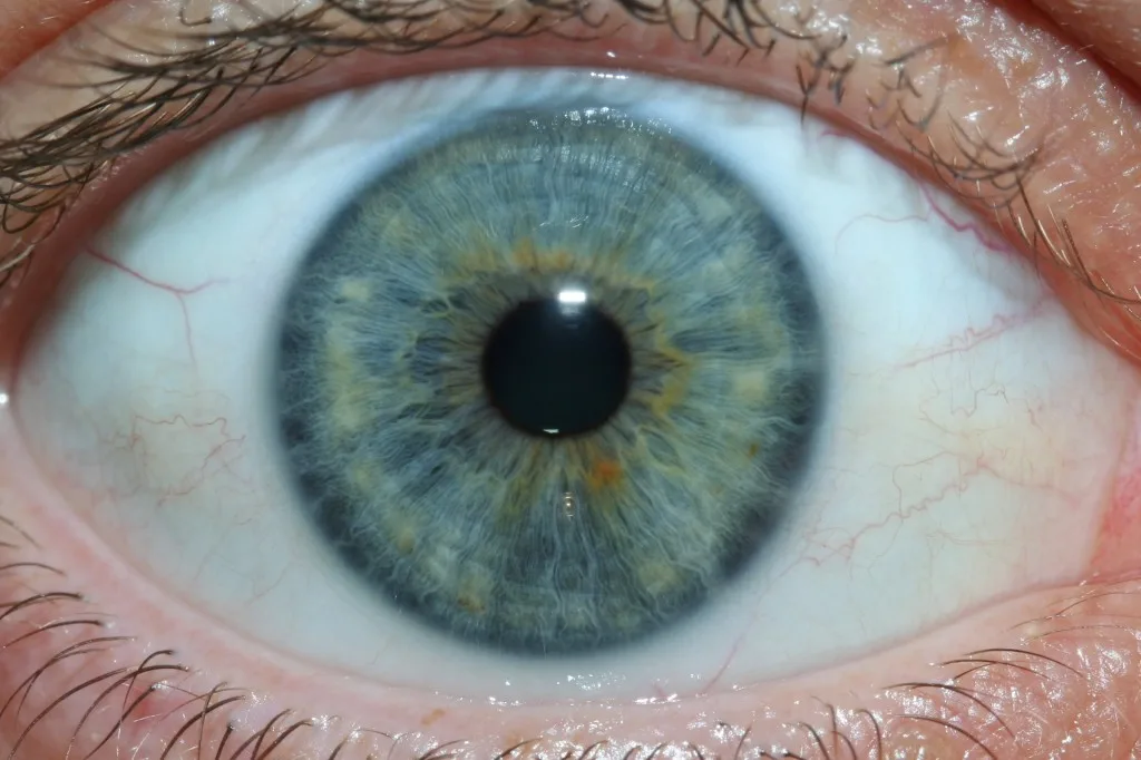 iridology eys images 3
