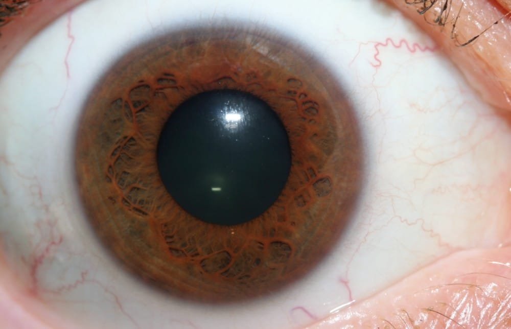 an Iris Under the Iridology Camera