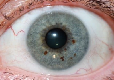 iridology images 30