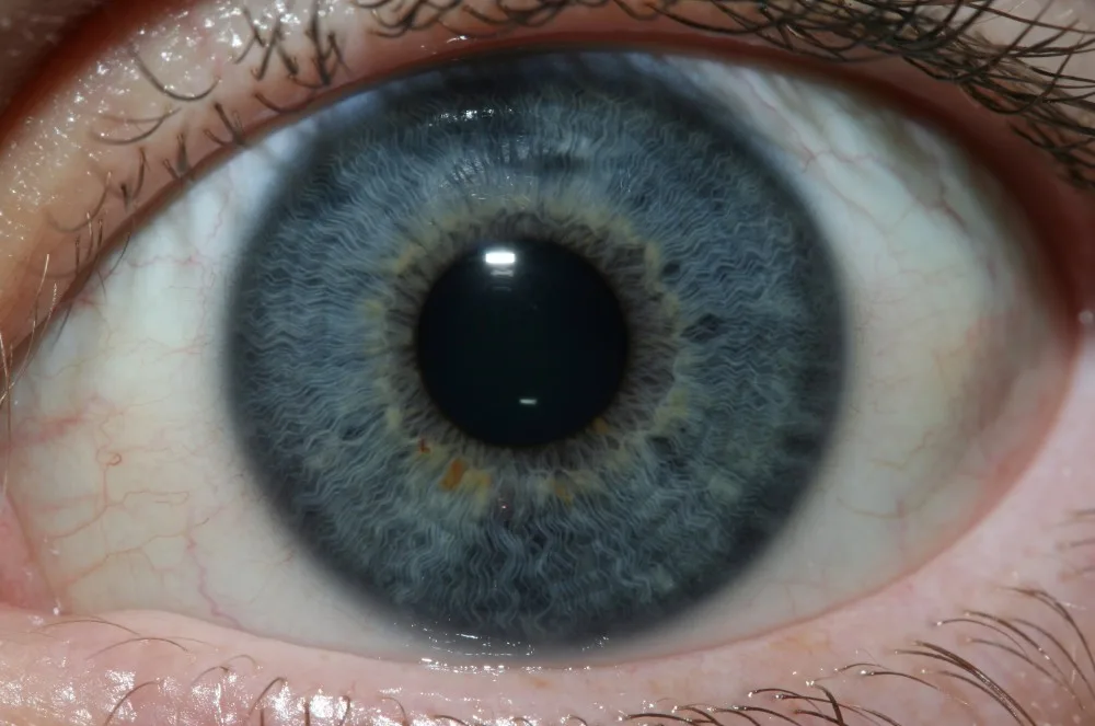 iridology images