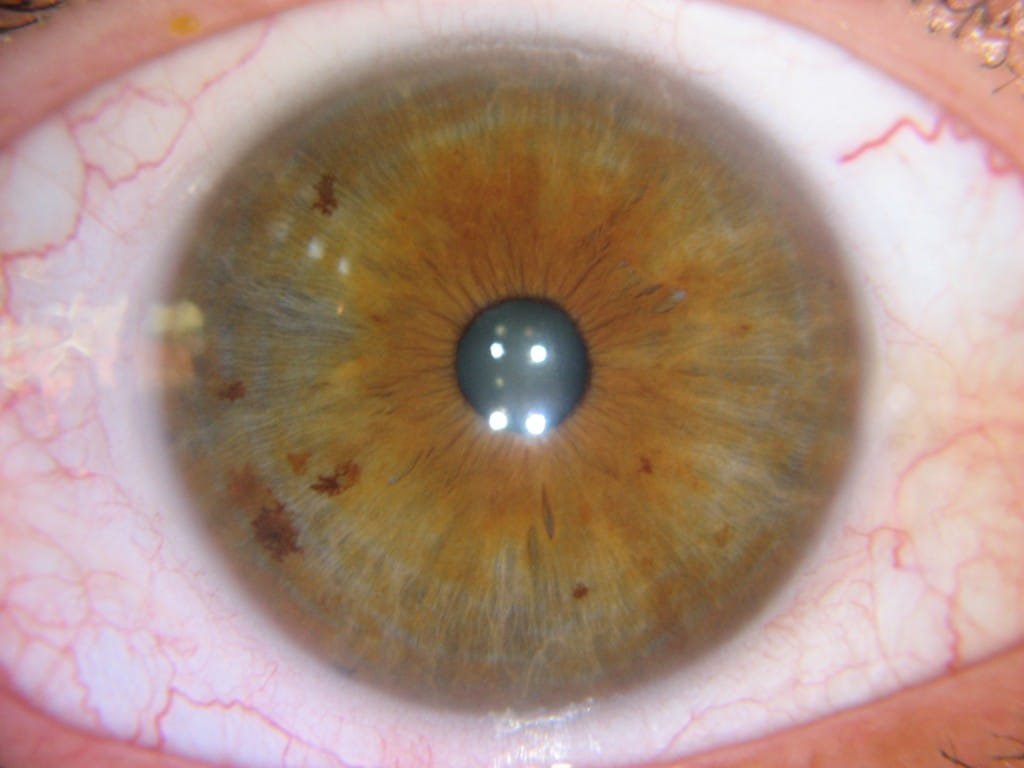 iridology liver Case Reading 6 iridology liver Case Reading 3