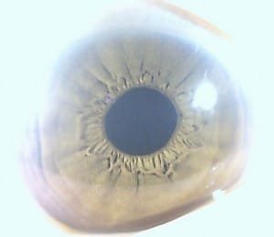 56 PCS iridology pictures