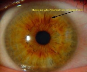 Nerve Rings Iridology ,Examples,Images – MAIKONG Iridology Camera