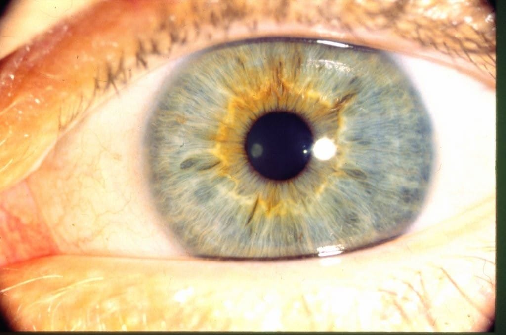 What And Why Iridology Yellow Ring Around Pupil Iriscope Iridology 