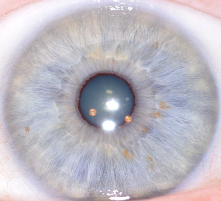 iridology images 5