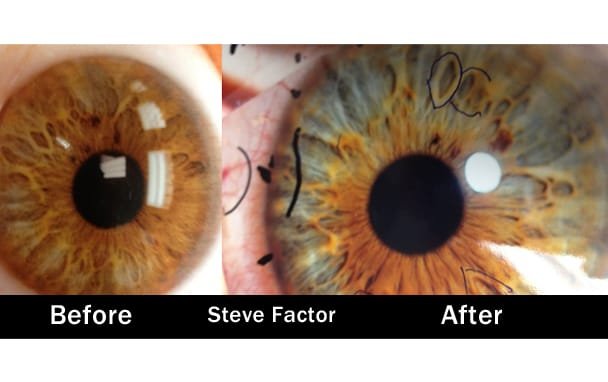 Before and after comparison photographs showing potential iris color changes over time