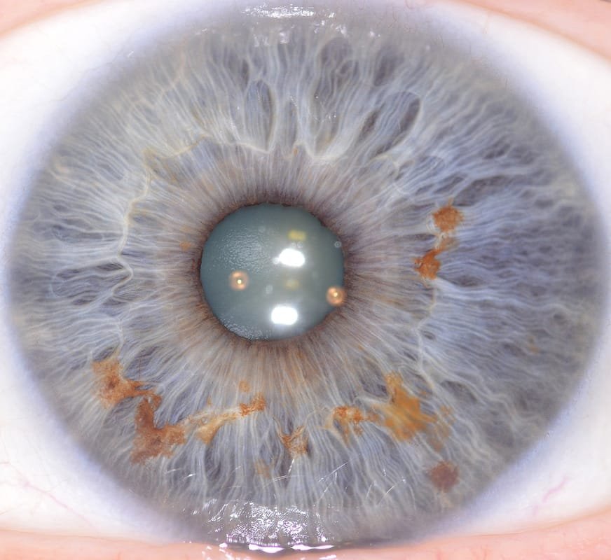 iridology camera take iridology images