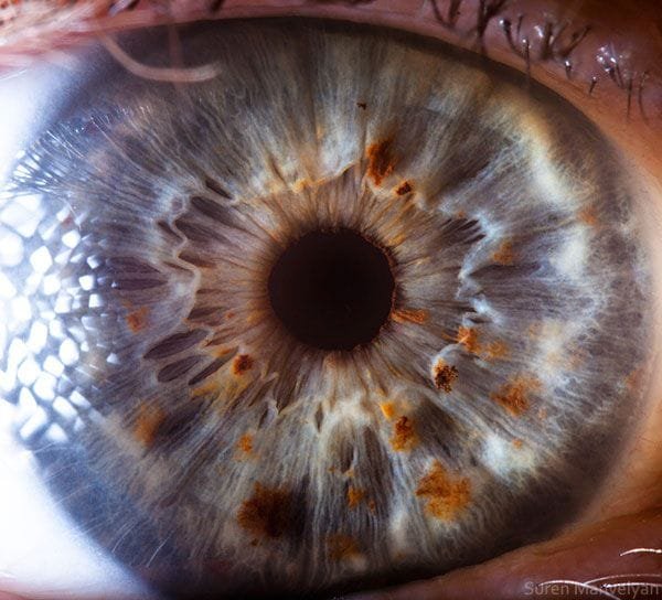 iridology pictures