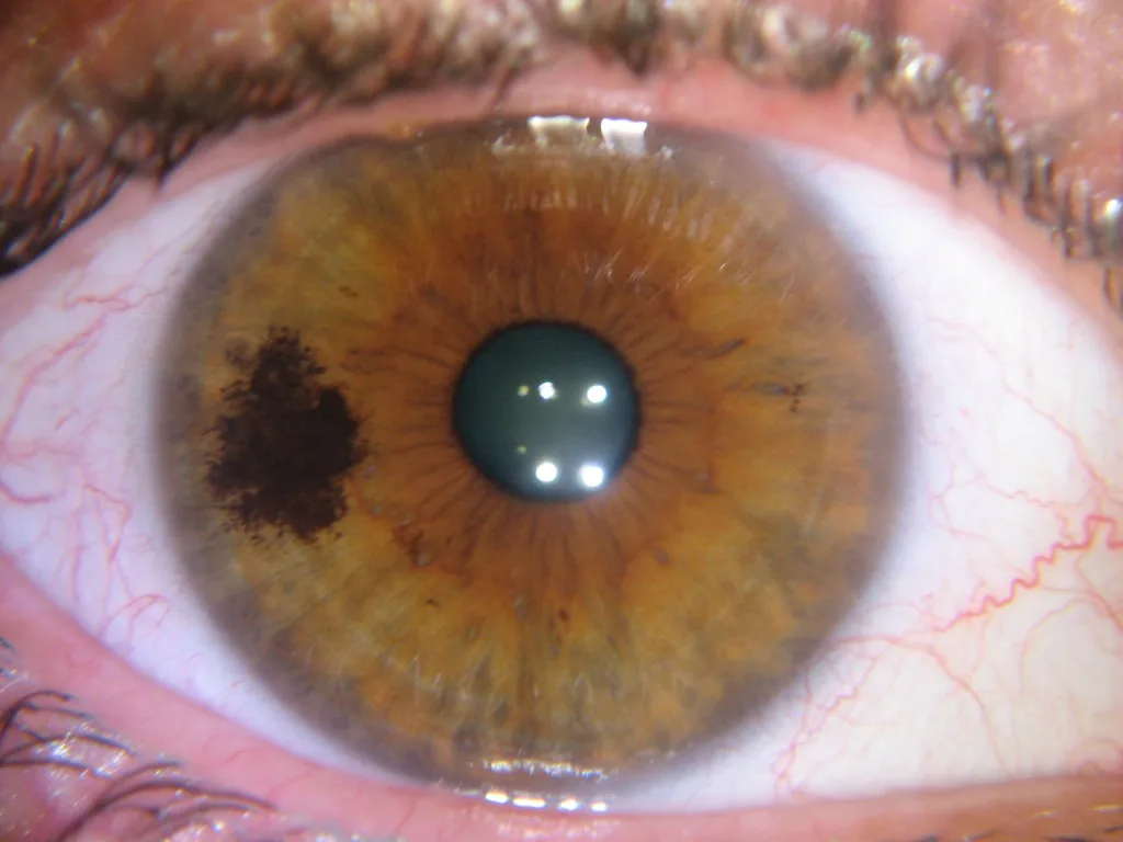 iridology yellow ring around pupil 4