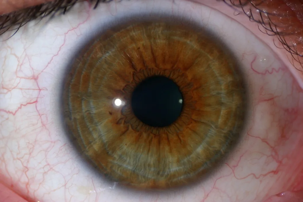 iridology yellow ring around pupil 7