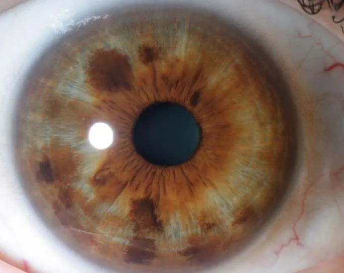 iridology zones dark spot kidney