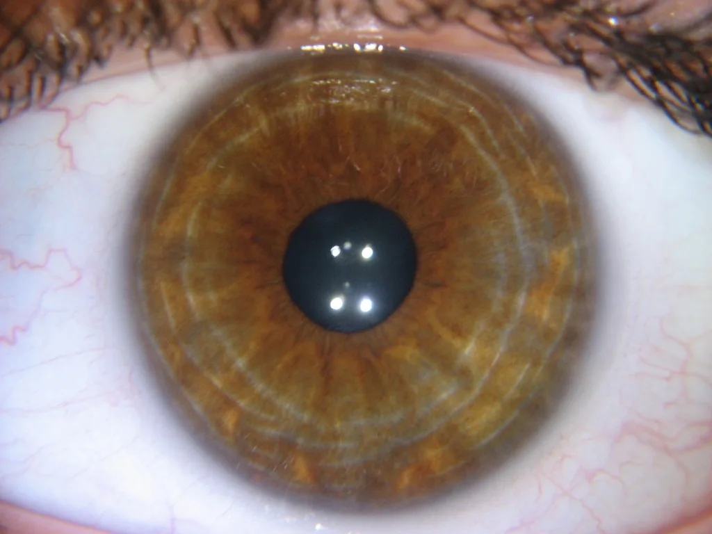 iridology yellow ring around pupil 9