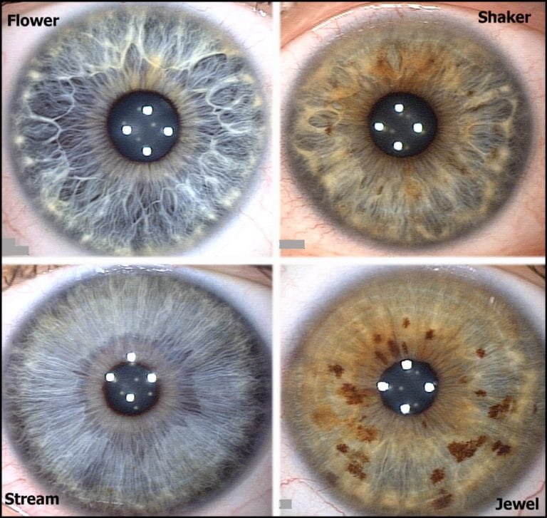 What is iris color chart? | iriscope | iridology camera | iriscope ...