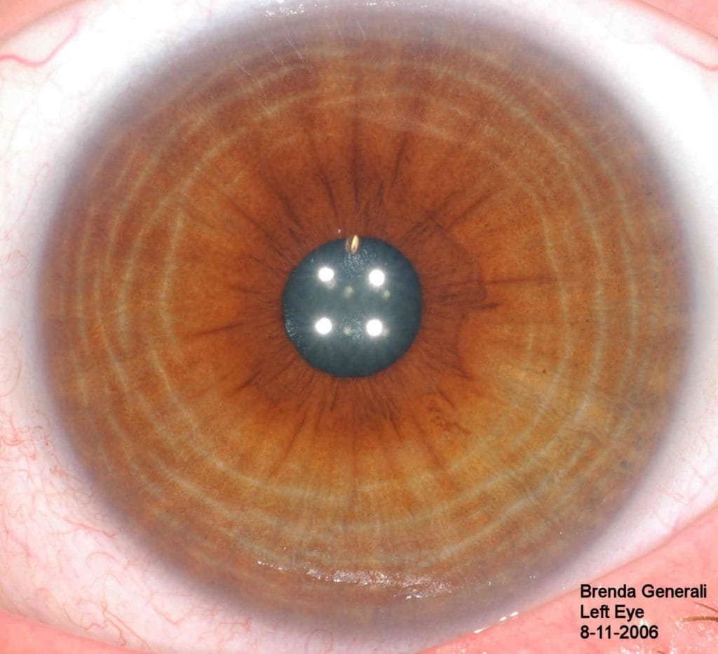 What is iris color chart? 2 iris color chart