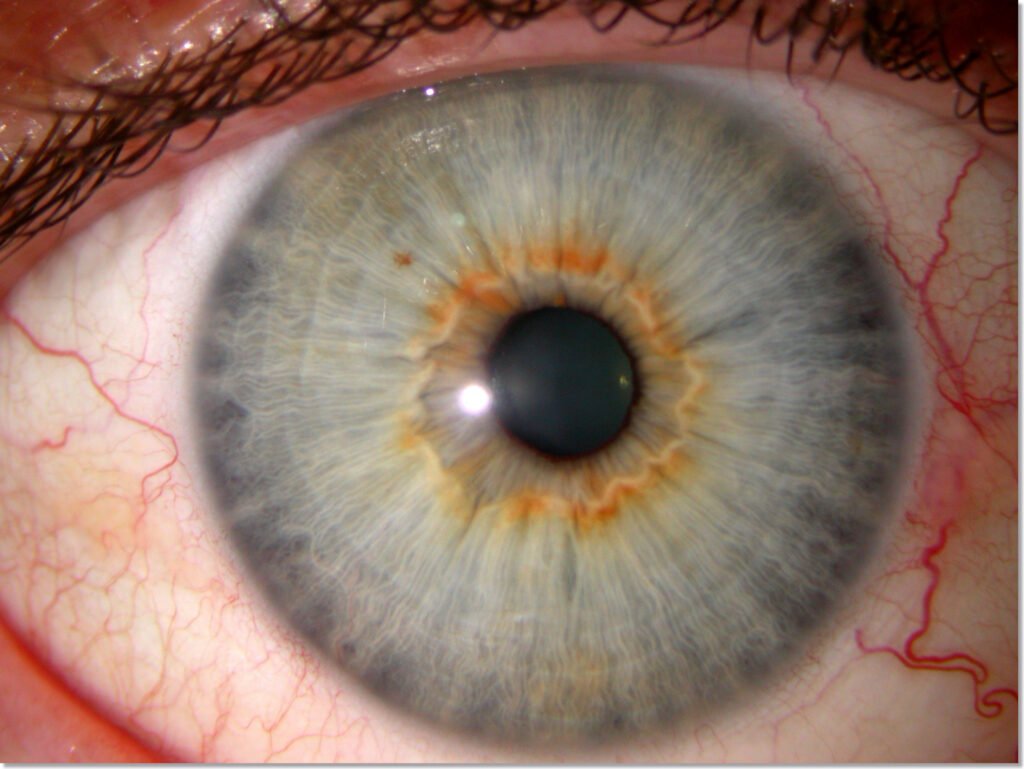 iridology analysis