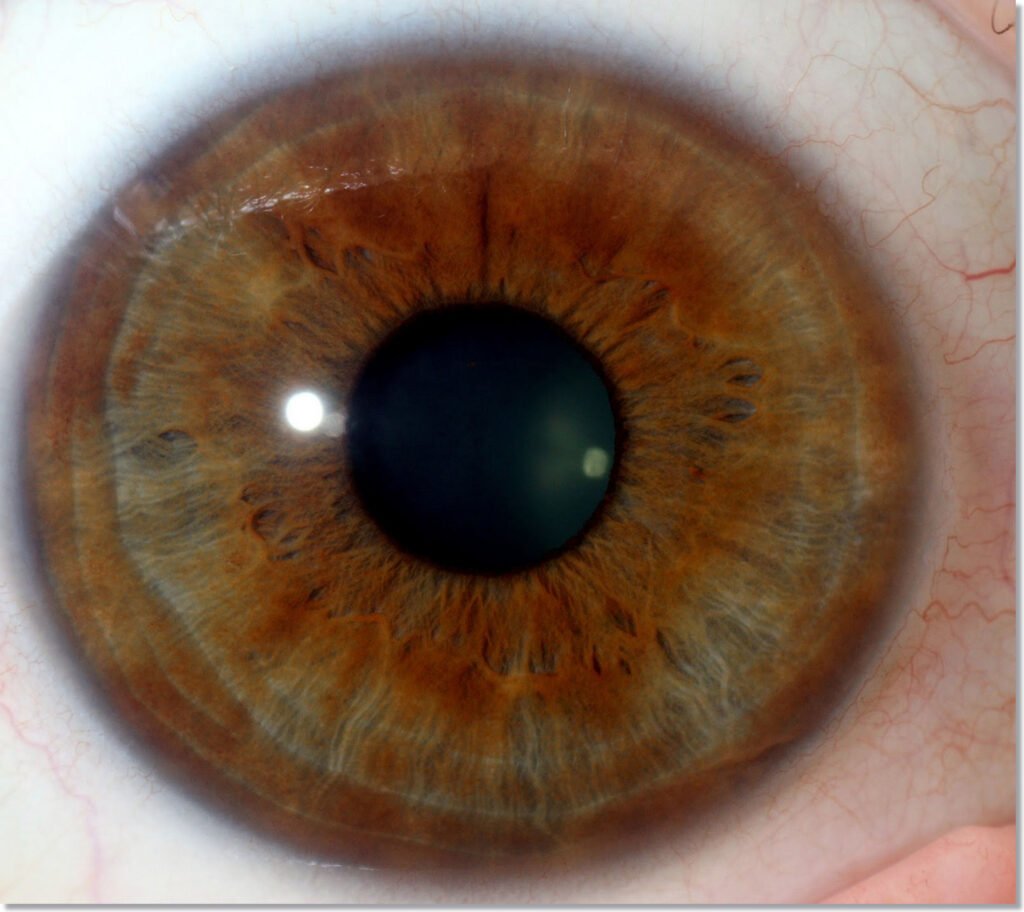 Iridology Yellow in Eye Color