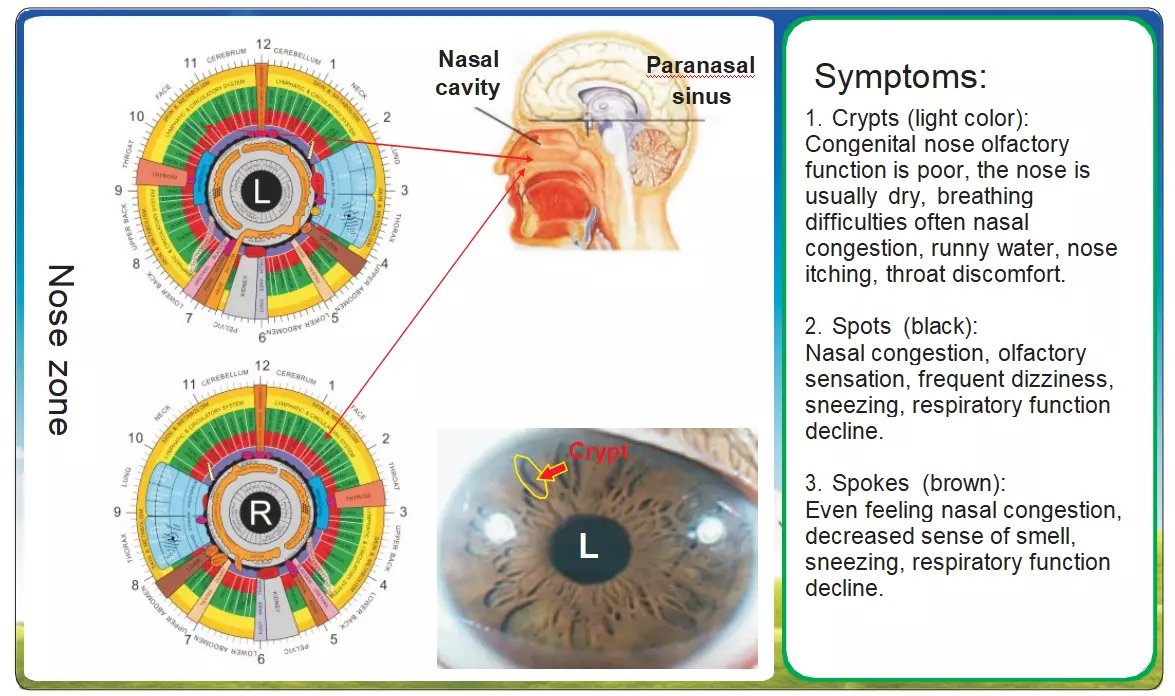 8.2 Iridology-Respiratory System Clinical Manifestations and Pathological Features of Nasal Disorders 1 Iridology-Respiratory System